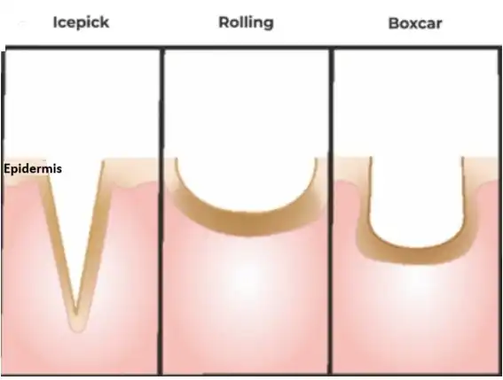 Before and after acne scar types by Dr. Amrika Seshadri